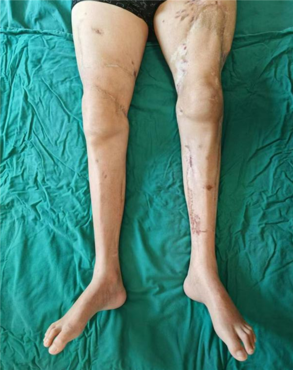 我国完成世界首例双大腿被绞断再植手术:男子20个月后恢复行走!