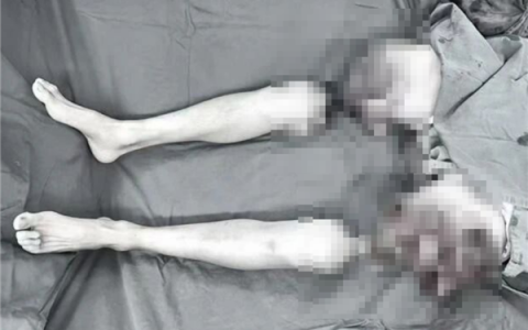 我国完成世界首例双大腿被绞断再植手术：男子20个月后恢复行走！