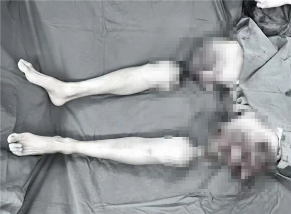 我国完成世界首例双大腿被绞断再植手术:男子20个月后恢复行走!